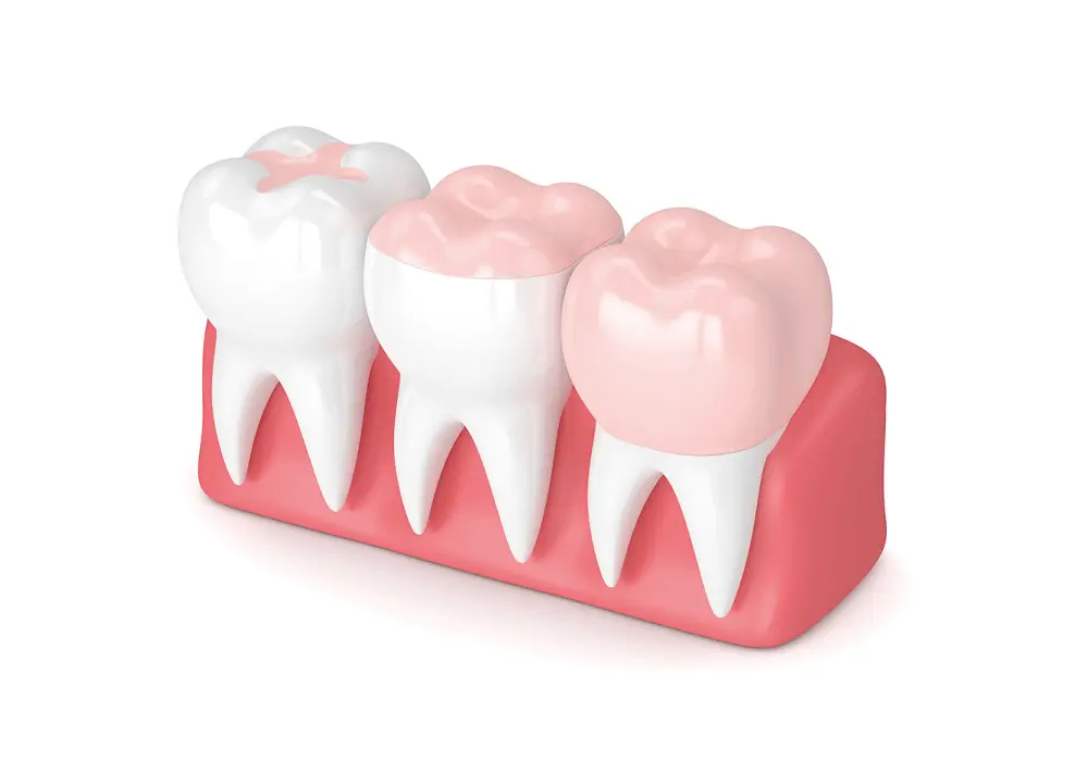 İnley Onley Porselen Dolgu Tedavisi