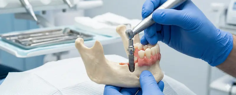 İmplant Tedavisi - Silivri Çatalca Diş Kliniği